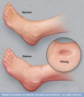 mcdc7_edema_foot